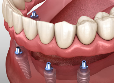 Implant-Supported Dentures